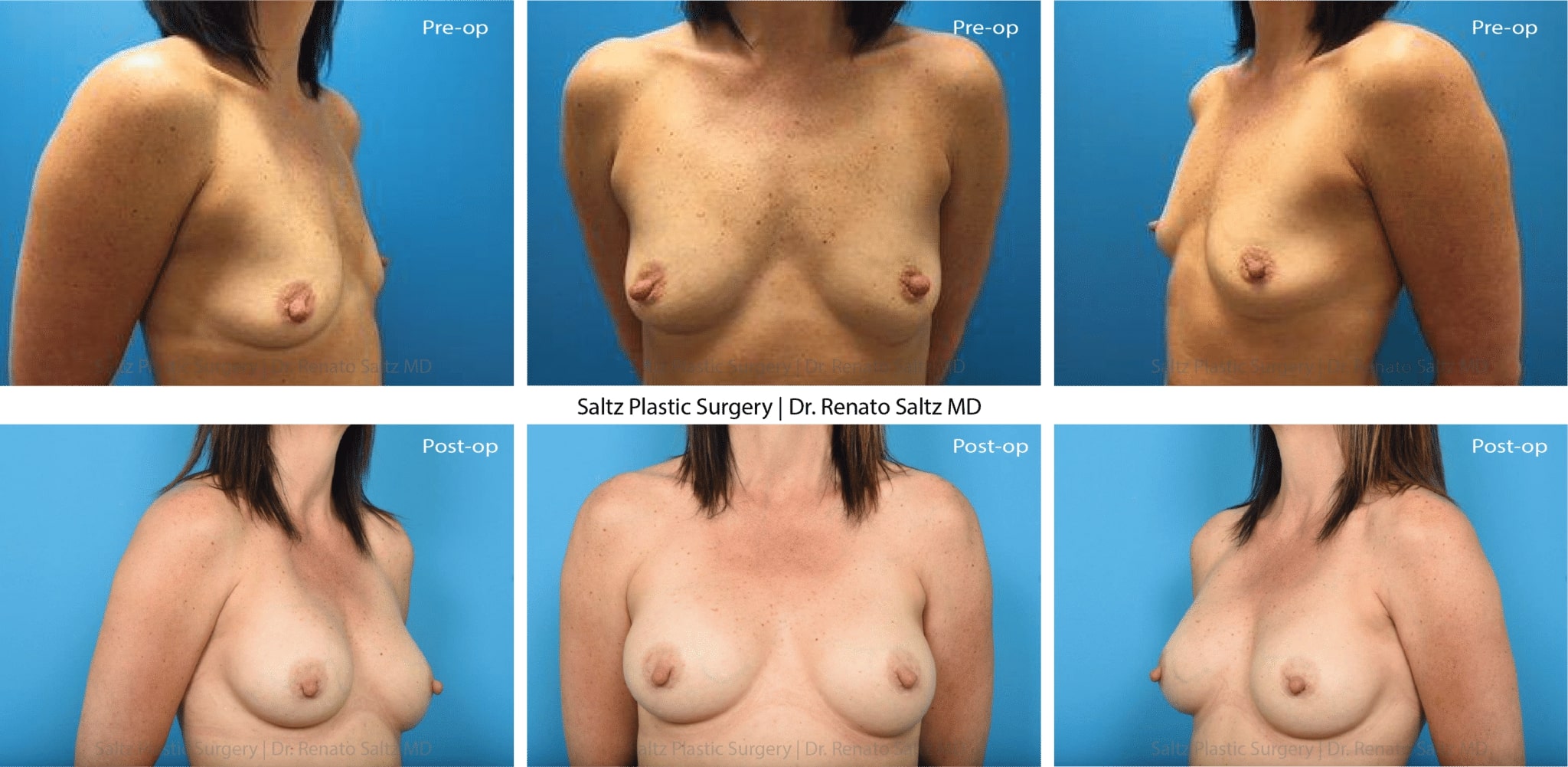 breast augmentation 2