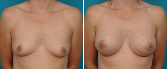 breast augmentation case 1
