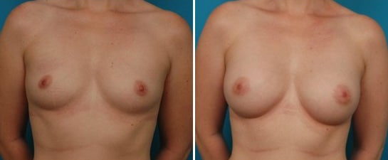 breast augmentation case 2