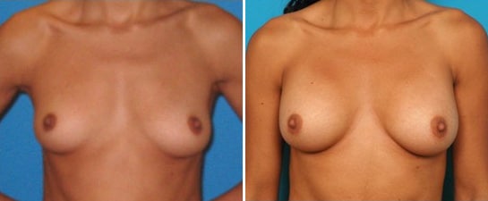 breast augmentation case 3