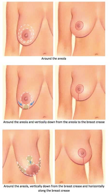 illustrations of breast lift techniques