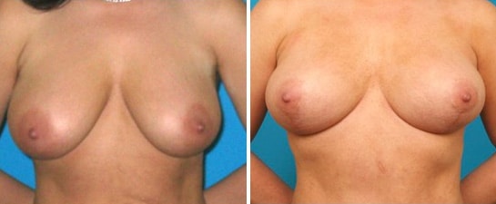 breast lift case 1