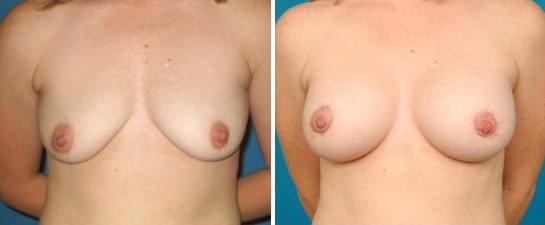 breast lift case 2