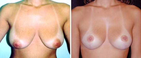 breast lift case 3