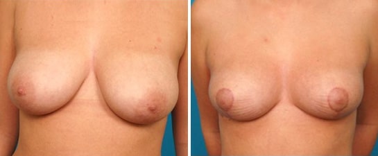 breast reduction case 2