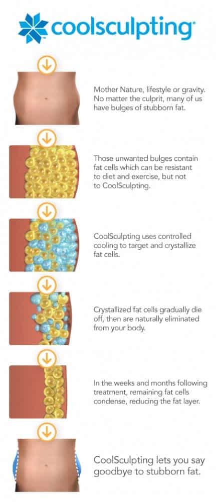 coolsculpting infographic showing illustrations of how treatment removes fat