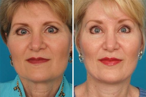 female patient’s face before and after facelift