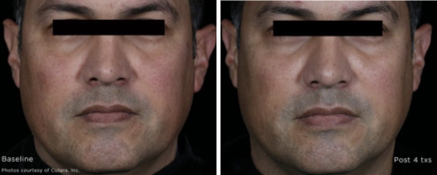 male patient’s face before and after laser genesis treatment