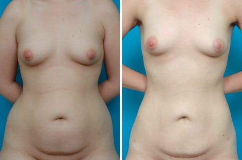 liposuction case 1