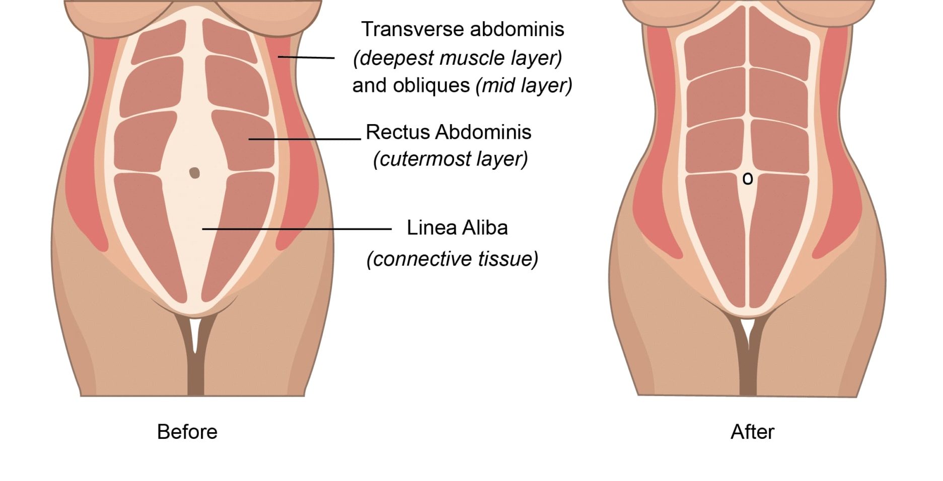 illustrated cross section of female abdomen before and after tummy tuck showing less fat and more muscle after procedure