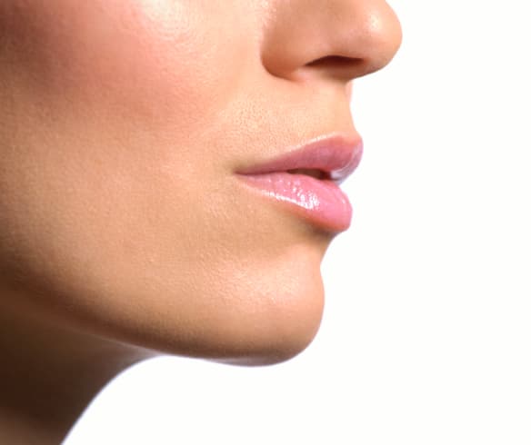 Chin Implant