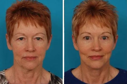 woman before and after laser peel skin resurfacing