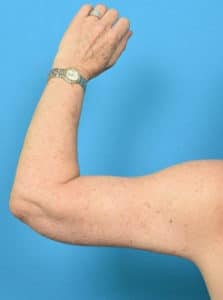 After Image: Arm Lift