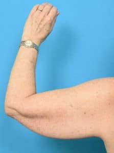 Before Image: Arm Lift