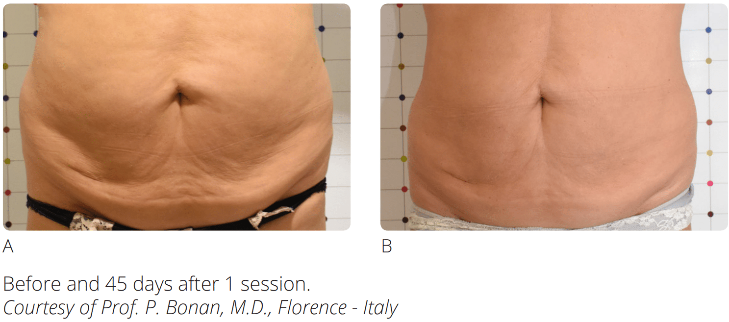 patient’s bare stomach before and after Sentient Sculpt body contouring, flatter after procedure