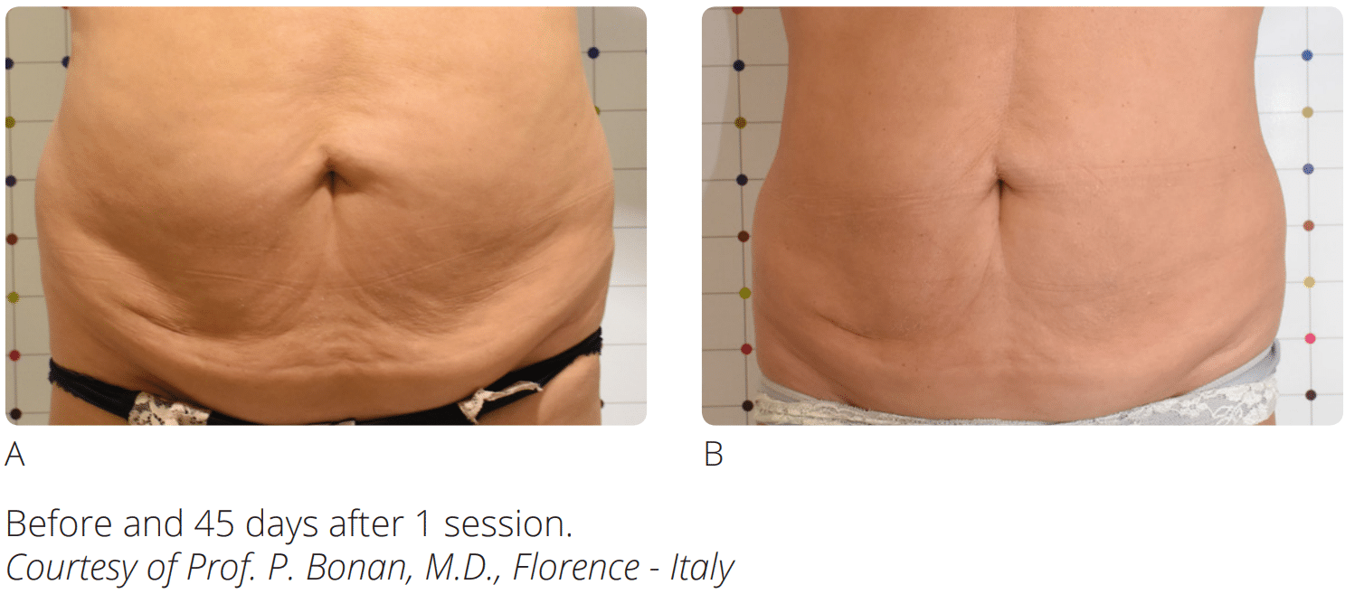Before & After Image of Sculpt Salt Lake City UT