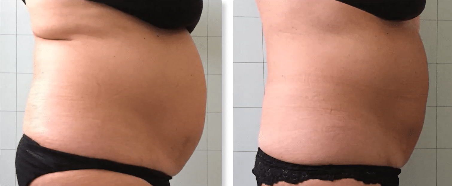 Before & After Image of Sculpt Park City UT