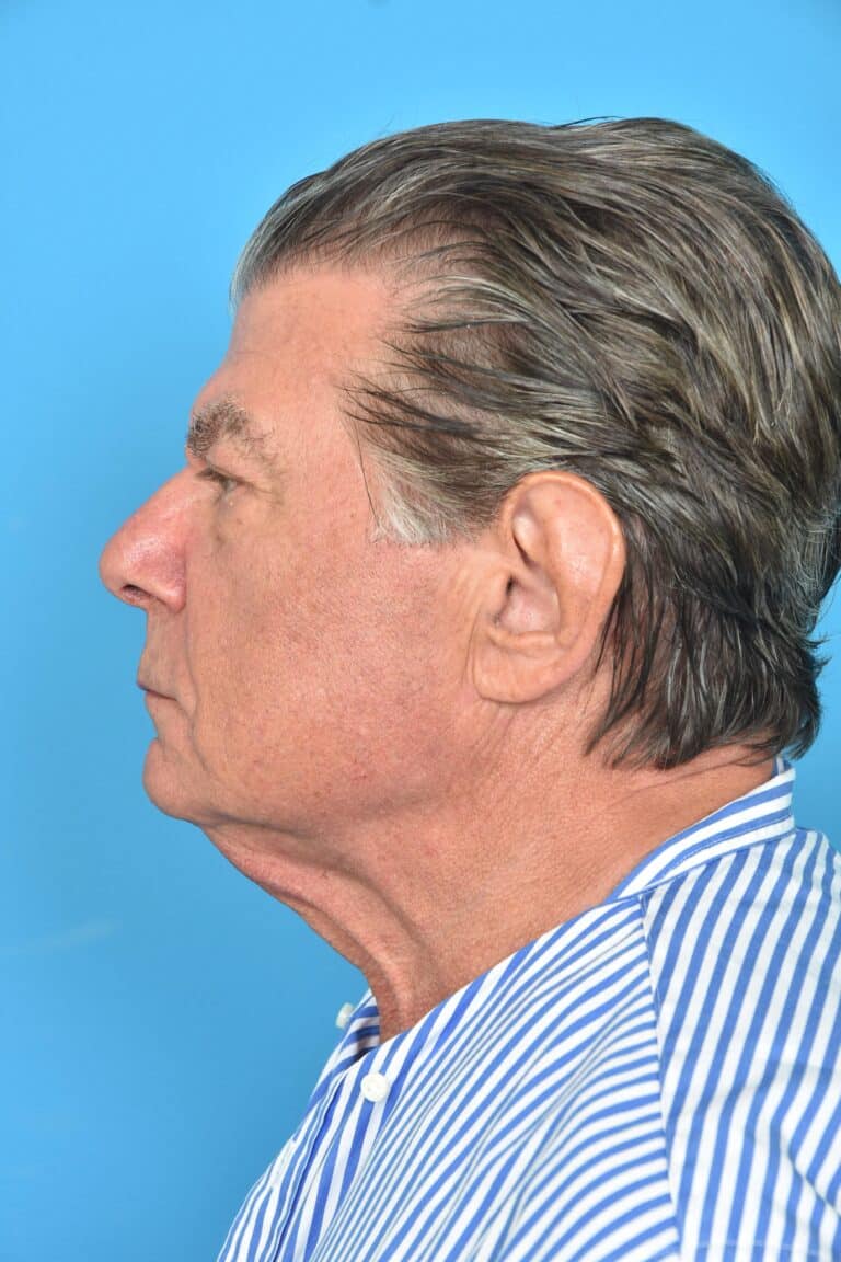 Before Image: Before and After Neck Lift - left-side