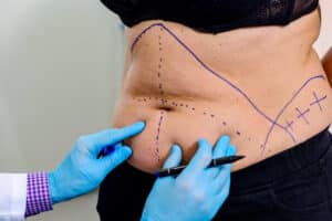 Preparing for liposuction in Salt Lake City, UT