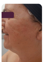 After Image: WonderTouch Before and After - left-side