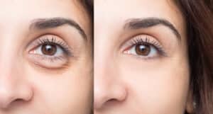 Before and after photo showing woman with under-eye bags and after eyelid surgery