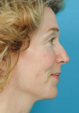After Image: Facial Rejuvenation - right