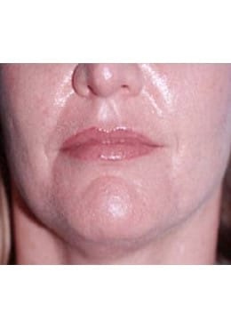 After Image: Lip Augmentation - close-up