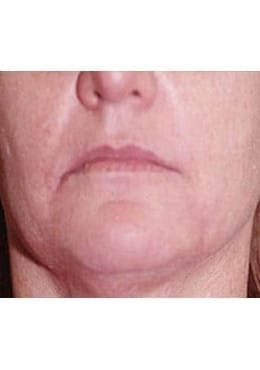 Before Image: Lip Augmentation - close-up