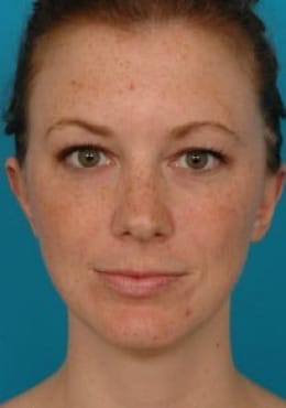 After Image: Otoplasty - front