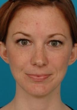 Before Image: Otoplasty - front