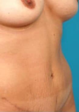 After Image: Mommy Makeover - oblique right
