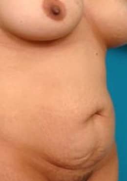 Before Image: Mommy Makeover - oblique right