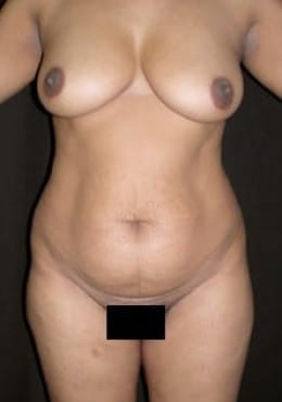 Before Image: Mommy Makeover - front