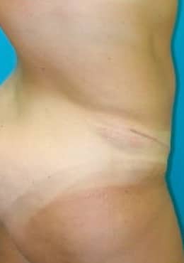 After Image: Body Contouring - right