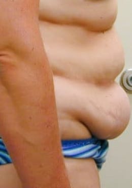 Before Image: Body Contouring - right