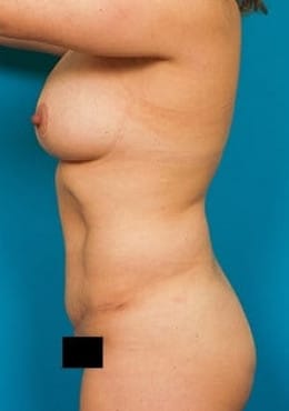 After Image: Mommy Makeover - front