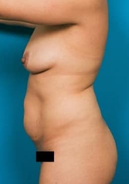 Before Image: Mommy Makeover - front