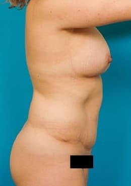 After Image: Mommy Makeover - front