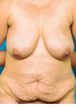 Before Image: Mommy Makeover - front