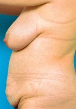 Before Image: Mommy Makeover - front