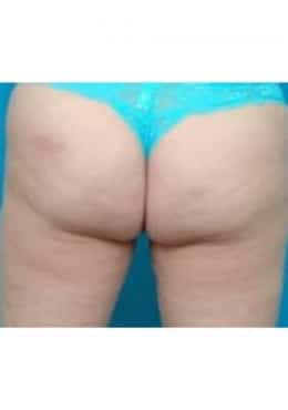 After Image: Cellfina - rear