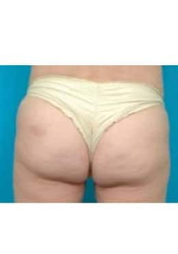 After Image: Cellfina - rear
