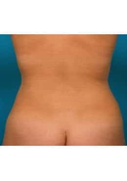 After Image: Liposuction - rear