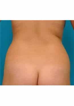 Before Image: Liposuction - rear