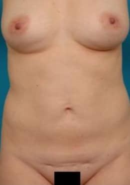 Before Image: Tummy Tuck - front