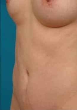 After Image: Tummy Tuck - oblique left