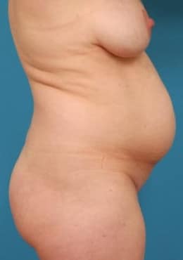 Before Image: Tummy Tuck - right