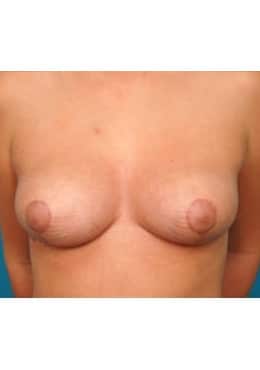 Breast Reduction