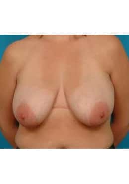 Before Image: Breast Reduction - front