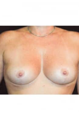 Breast Lift